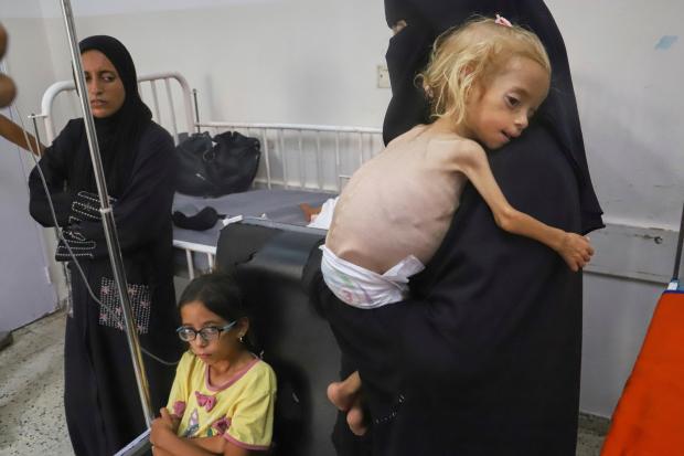 Islam Qudeih holds her severely malnourished shirtless, 2-year-old daughter, Shamm,...