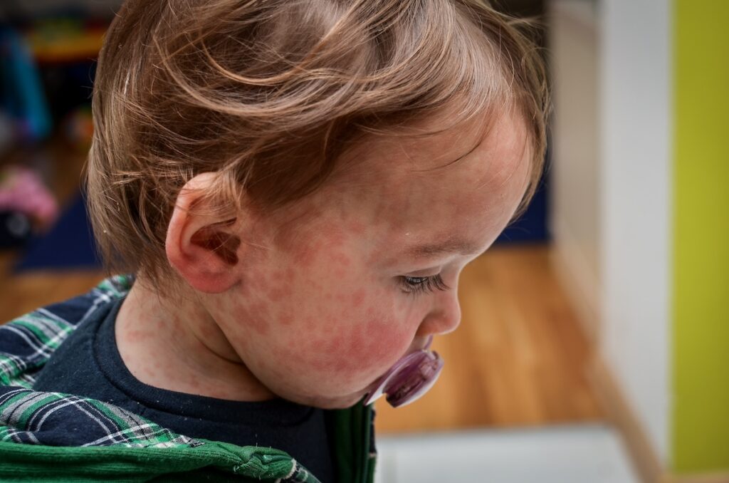 Florida health officials report another seven measles cases