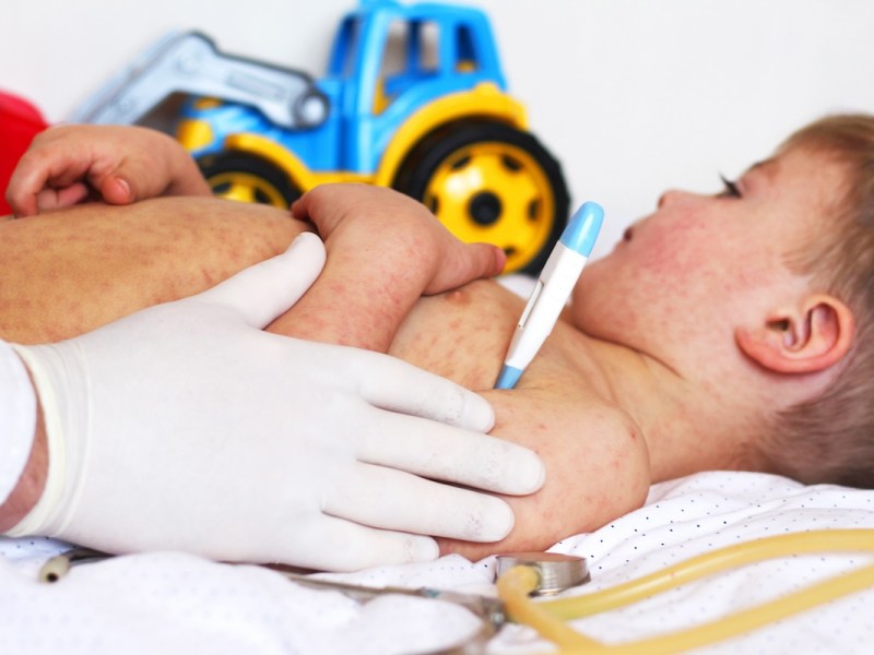 Measles cases have reached a 35-year high