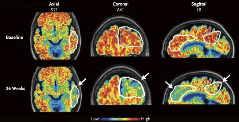 When it comes to Alzheimer’s, we can be our own best advocates | Opinion